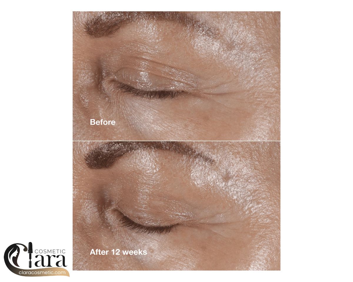 کرم دور چشم اسمارت کلینیک اسمارت