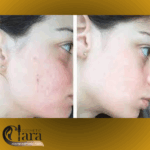 خرید سرم لایه بردار لاکتیک اسید 10% اوردینری