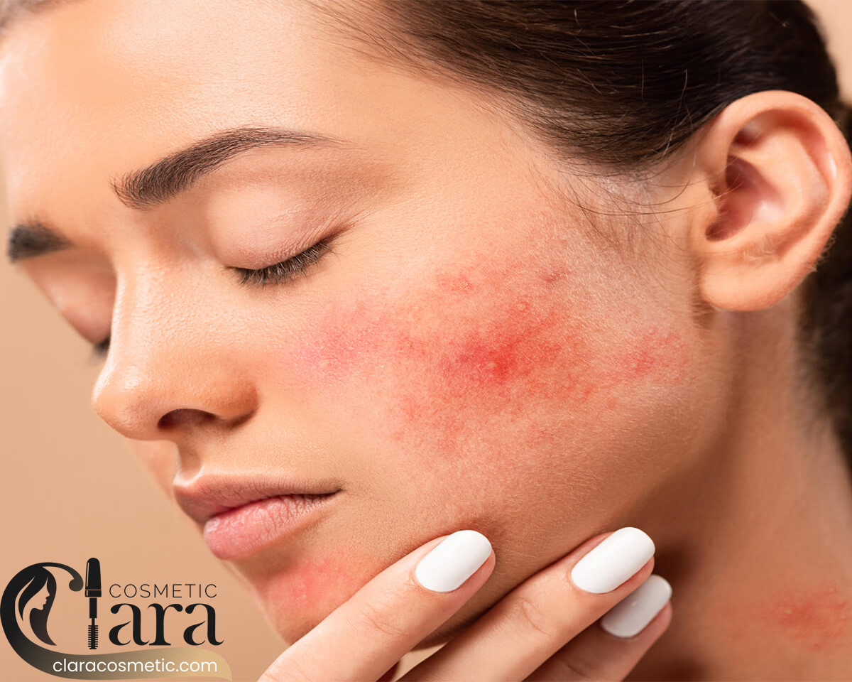 بهترین سرم اوردینری ضد جوش و رفع جای جوش